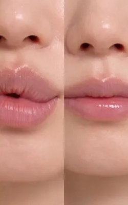 입술필러